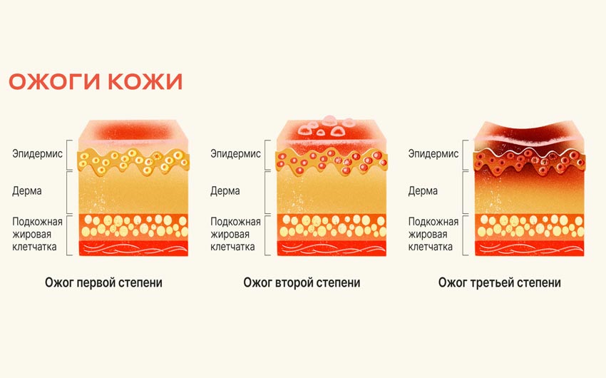 Лечение ожогов в домашних условиях