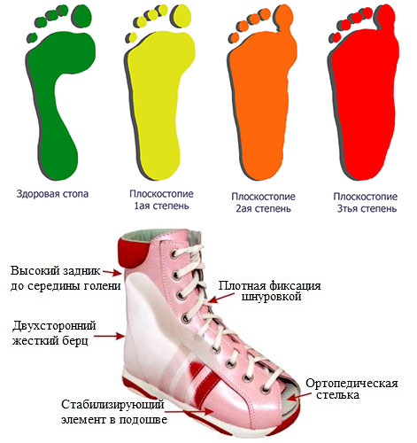 Лечебная ортопедическая обувь при плоскостопии у детей - польза и правила  выбора