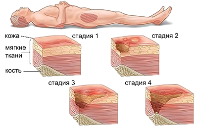 Опрелости и пролежни: как лечить на разных стадиях